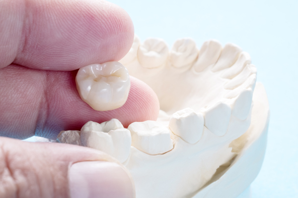 Types Of Dental Crowns