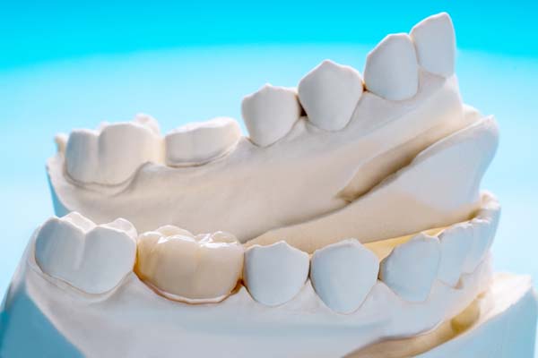 When Is Getting A Dental Crown Necessary?