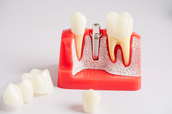 Simple Steps To Place Dental Implants