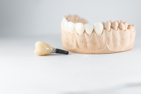 What To Ask Your Dentist About Dental Implants